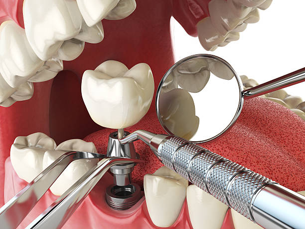 Best Emergency Tooth Extraction in Angwin, CA